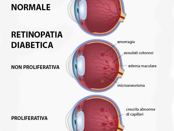 retinopatia diabetica con edema maculare, Valeria Vannucci, Metodo Boel Bologna