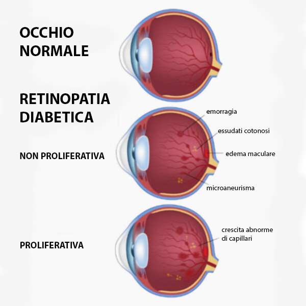 retinopatia diabetica con edema maculare, Valeria Vannucci, Metodo Boel Bologna