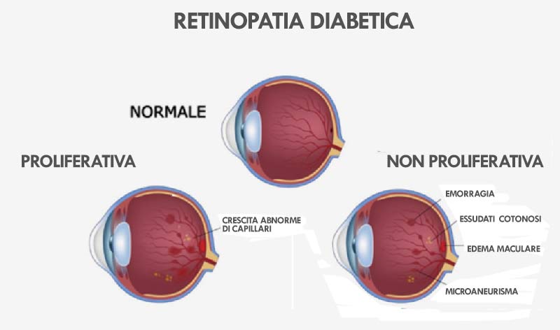 retinopatia diabetica, agopuntura Boel, cure naturali retinopatia diabetica