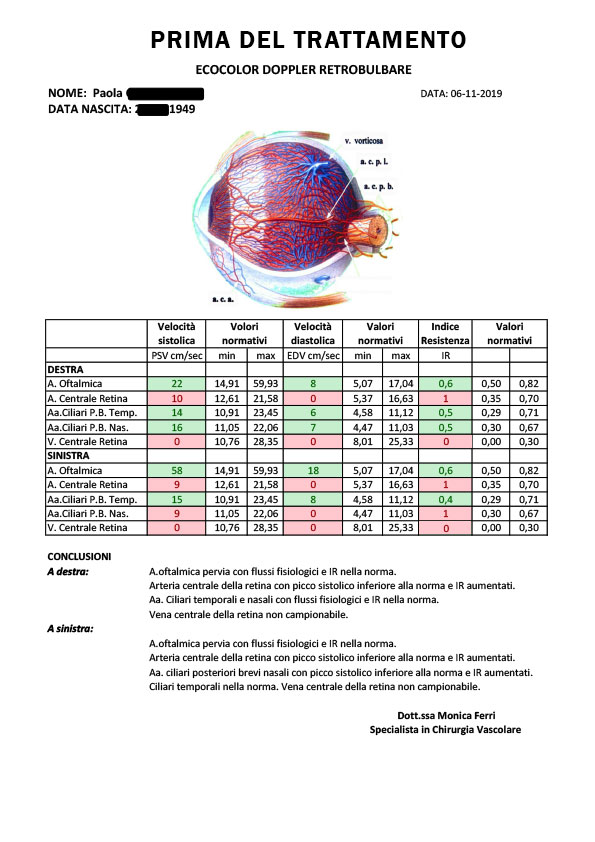 glaucoma sine tensione, ecocolordoppler prima e dopo i trattamenti di agopuntura boel, glaucoma