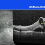edema-maculare, recensioni dei pazienti curati con metodo boel, come guarire da edema maculare?