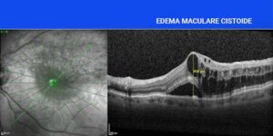 edema-maculare, recensioni dei pazienti curati con metodo boel, come guarire da edema maculare?