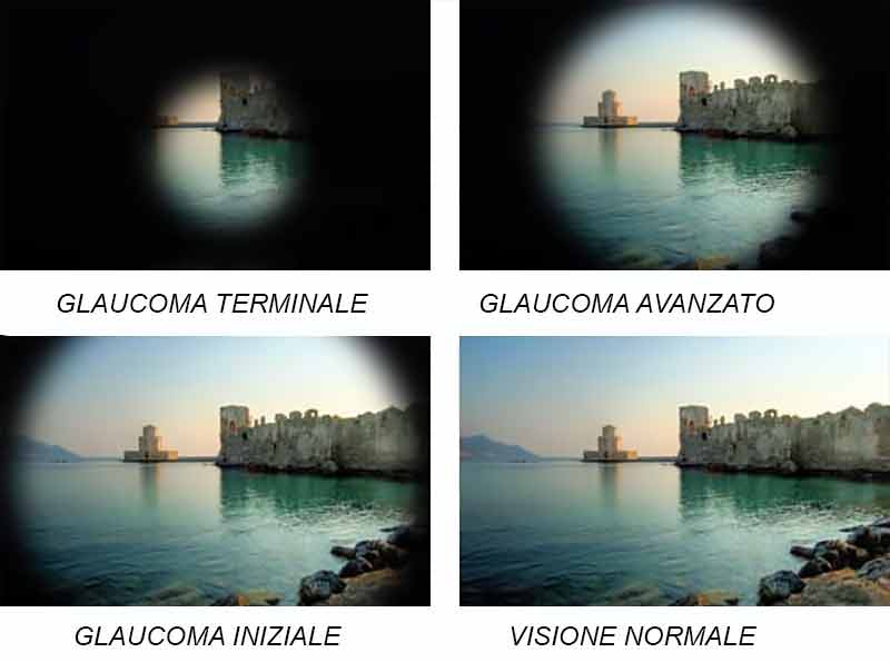 glaucoma visione a tunnel, il trattamento del glaucoma con agopuntura boel, glaucoma e agopuntura boel, cura glaucoma, glaucoma sintomi
