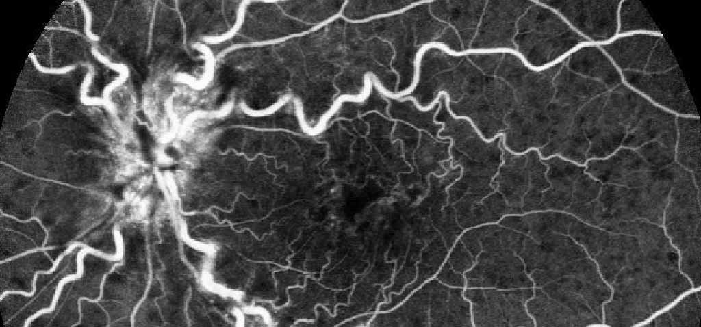 occlusioni vascolari retiniche, edema maculare, iniezioni intravitreali