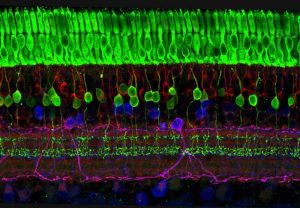 strati di cellule nervose della retina, retinite pigmentosa,